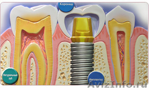 Имплантология зубов в городе Кирове - Изображение #1, Объявление #1128021